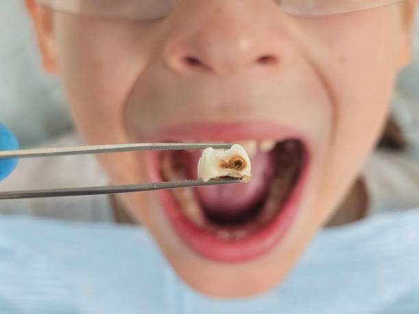 Best Emergency Tooth Extraction in Chanute, KS